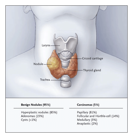 See Natural history of benign solid and cystic thyroid nodules.